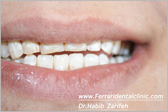 Hollywood Smile Cerec Veneers beirut lebanon