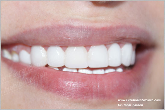 Hollywood Smile Cerec Veneers beirut lebanon