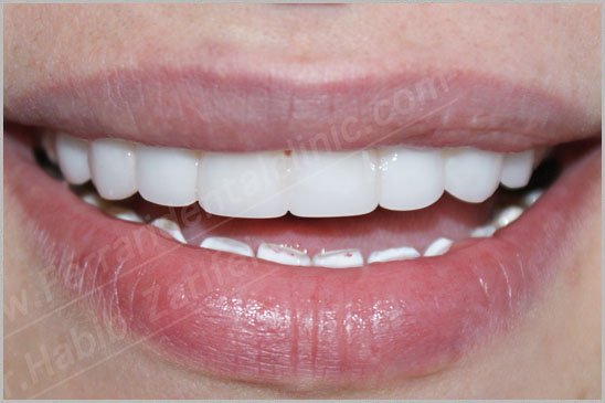 Hollywood Smile Cerec Veneers beirut lebanon