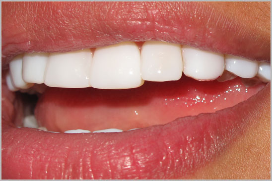 Hollywood Smile Composite veneers beirut lebanon