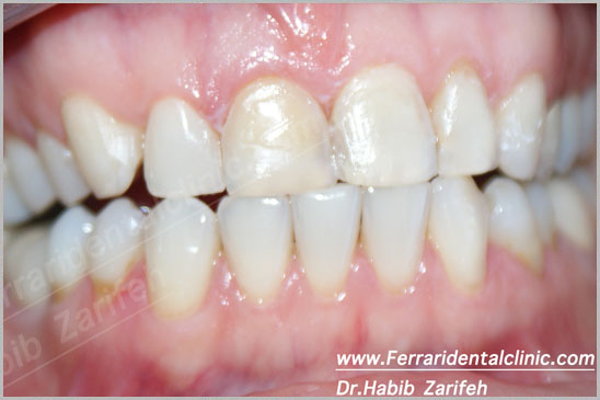 Veneers Hollywood Smile 