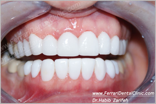 Veneers Hollywood Smile 