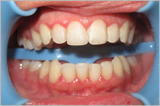 Veneers Hollywood Smile 