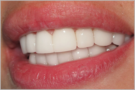 Veneers Hollywood Smile 