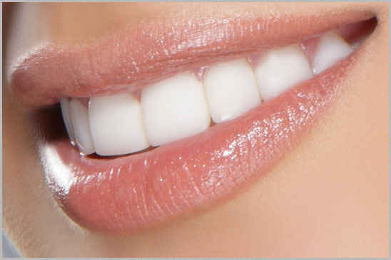 Laser bleaching Beirut Lebanon Hollywood Smile