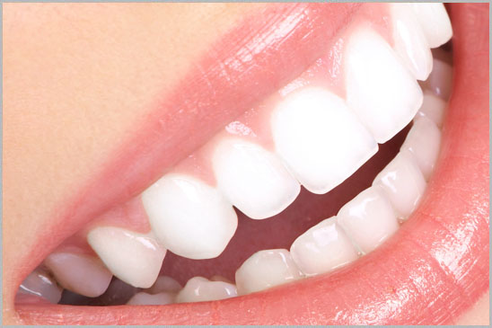 Laser Teeth Whitening Bleaching beirut lebanon Hollywood Smile 