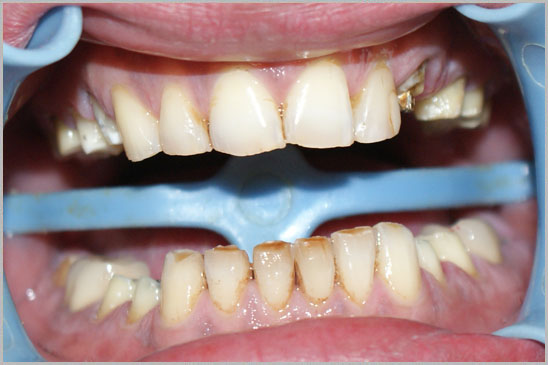 Zirconium Crowns Hollywood Smile