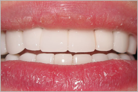 Zirconium Crowns Hollywood Smile